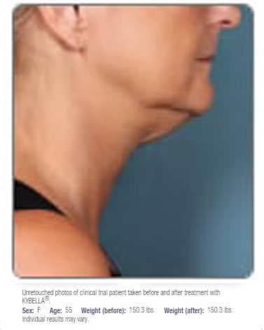 kybella results before